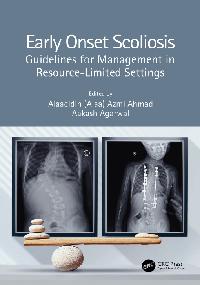 Early Onset Scoliosis by Agarwal, Aakash/Ahmad, Alaaeldin (Alaa) Azmi